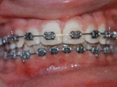 Mund med bøjle på tænderne.