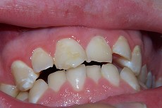 Tandsæt med syreskade