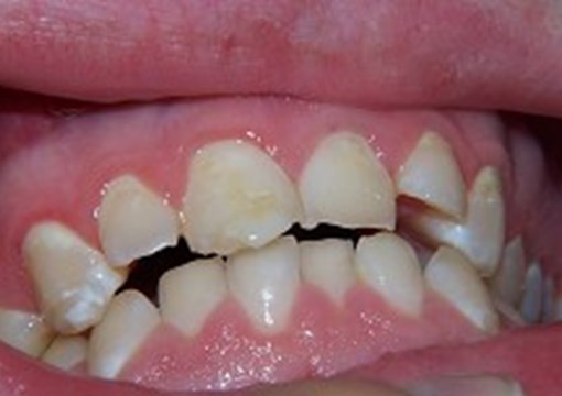 Tandsæt med syreskade